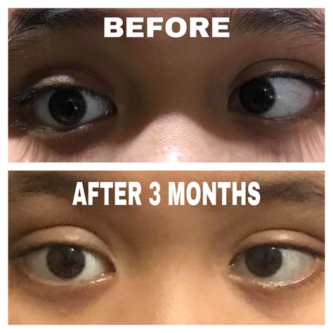 esotropia esotropia   juarez vision center