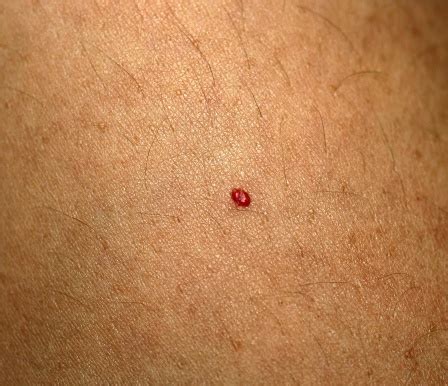Sinal De Nascença Vermelho - Foto de Angioma Sinal Vermelho No Corpo Marca De Nascença Na Pele e ...