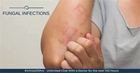 common fungal infections affecting  skin