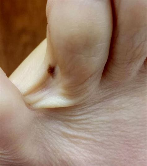Malignant Melanoma Foot