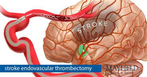 Stroke | Mayfield Brain & Spine, Cincinnati, Ohio