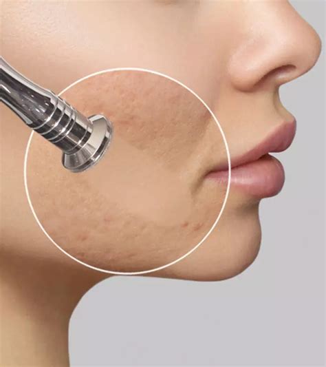 Microdermabrasion For Acne Scars: Benefits, Effects, & Cost