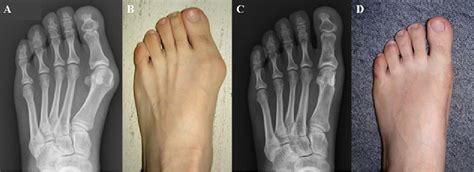 Figure 1 from Proximal Reverse Chevron Metatarsal Osteotomy, Lateral