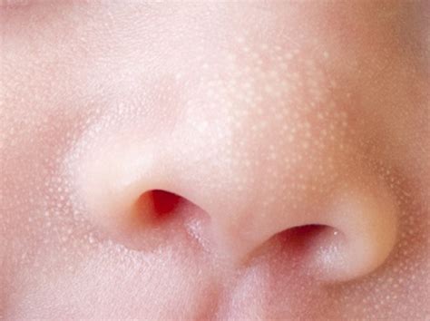 common newborn rashes