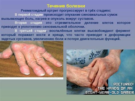 Псориатический артрит: симптомы и лечение, клинические рекомендации
