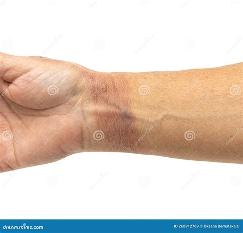 hot water burn   skin   hand stock image image  heat