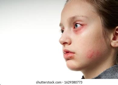 Allergic Reaction Skin Rash Close View Stock Photo (Edit Now) 1629380773