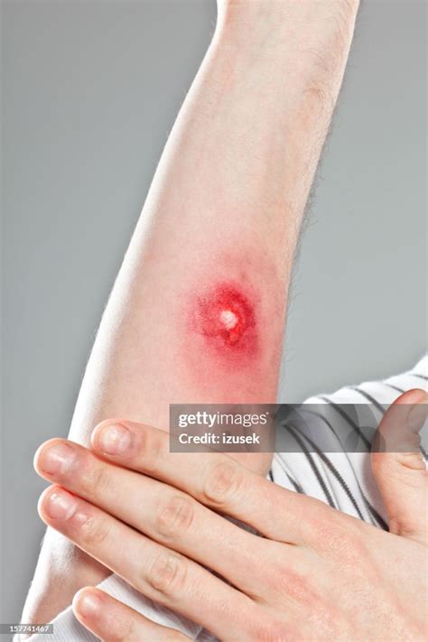 big insect bite high res stock photo getty images