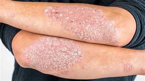 Заразен ли псориаз, передается ли он от человека к человеку? | MedAboutMe