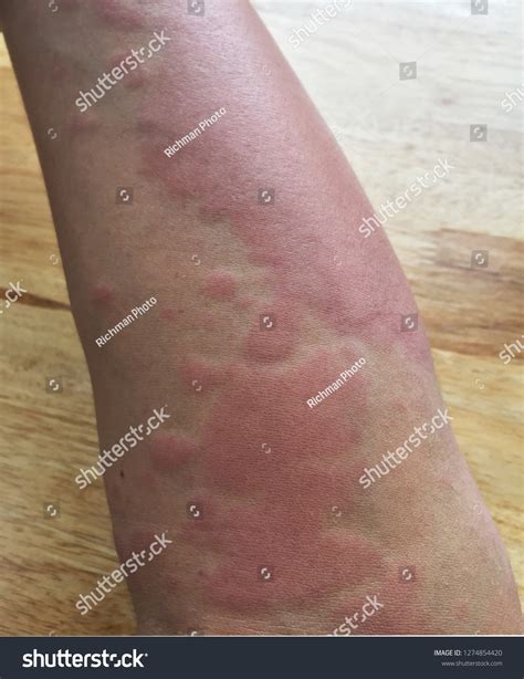 Bee Sting Allergic Reaction Arm