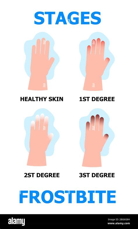 frostbite stages info graphic vector hypothermia  winter season