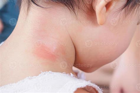 Alergia No Pescoço Do Bebê O Que Passar - erupção cutânea do bebê e alergia com mancha vermelha causada por ...