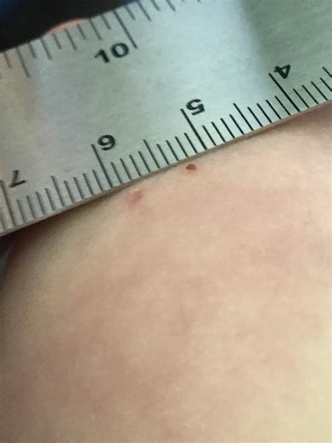 Could this be a bat bite? : Wildlife