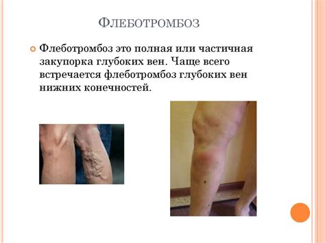 Флеботромбоз. Варикозное расширение вен нижних конечностей ...
