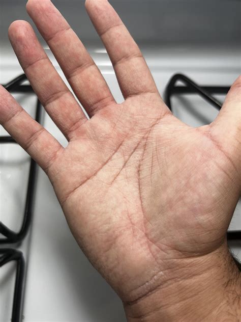My hands get like this whenever I have them in water for a while