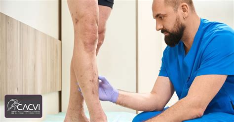 how much does it cost to remove varicose veins