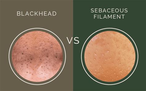 Clogged Pores Vs Blackheads