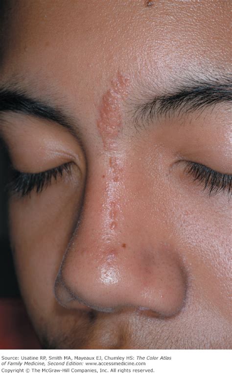 Epidermal Nevus Face