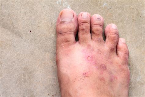 Psoriasis On Feet Psoriasis On Feet: How To Manage And Treat, Plus