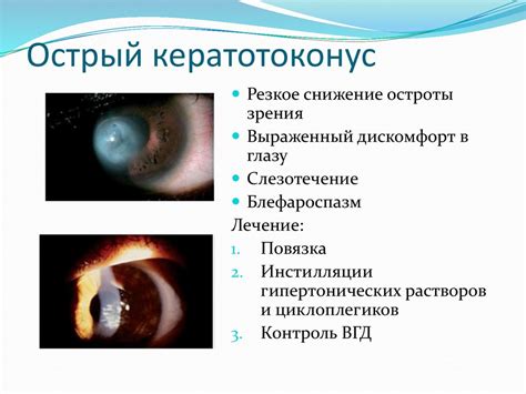 Кератиты. Заболевания роговицы - презентация онлайн