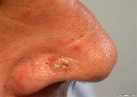 BCC (Basal Cell Carcinoma)