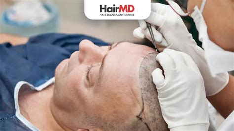Side Effects of Hair Transplant | HairMD Pune