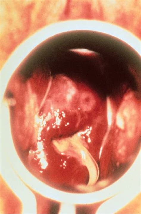 pelvic infections review  medical microbiology  immunology