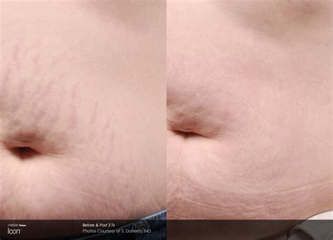 Laser Stretch Mark Removal Rockville & Potomac MD