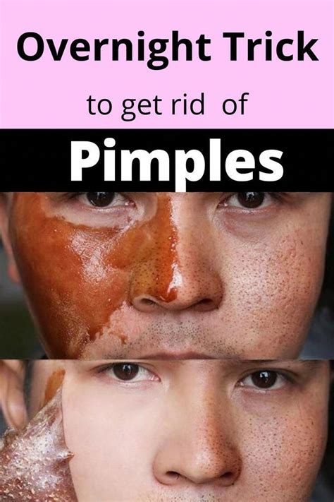 how to get rid of pimples in hair