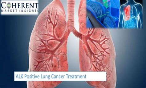 ALK Positive Lung Cancer Treatment Market Benefit and Volume