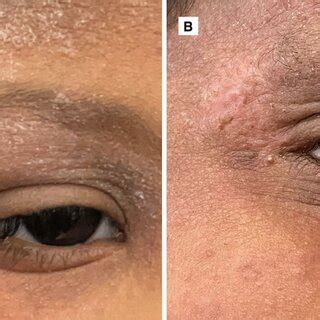 Histopathologic examinations of angiolymphoid hyperplasia with ...