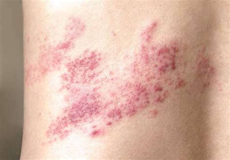 Shingles Rash Look Like