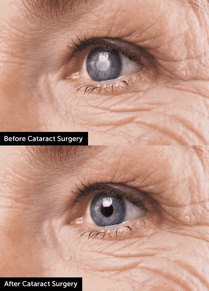 Cataract Eye Surgery in Iowa | Wolfe Eye Clinic