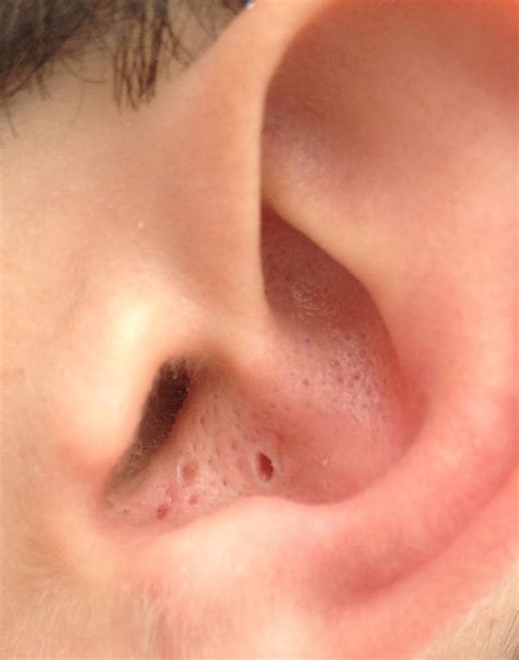 Blackhead Popping Tool