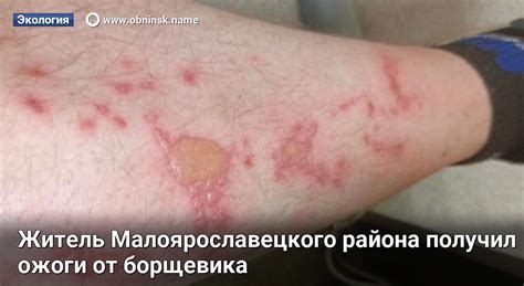 Житель Малоярославецкого района получил ожоги от борщевика