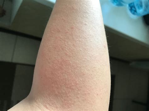 Виды сыпи на руках фото и описание