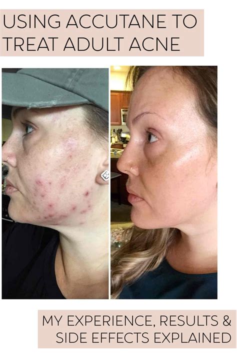 Accutane for Adult Acne: My Experience