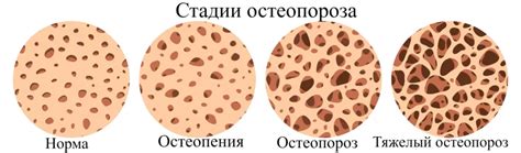 Ювенильный остеопороз — симптомы, причины, диагностика и лечение