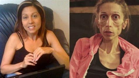 Una mujer con anorexia difunde un vídeo para alertar sobre la enfermedad
