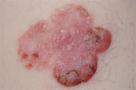 Болезнь Боуэна (МКБ-10: D04) 🚨 - Online AI Dermatologist