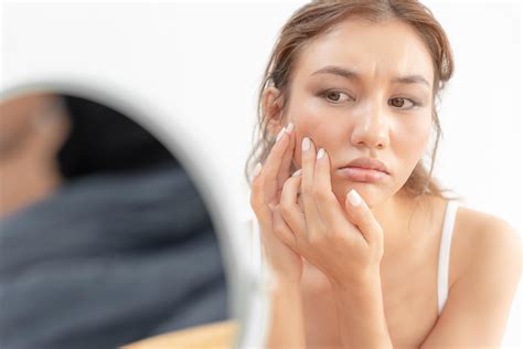 Face Acne From Steroids at John Richard blog