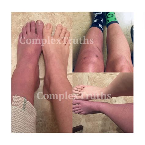 Crps of the lower leg and foot – Artofit