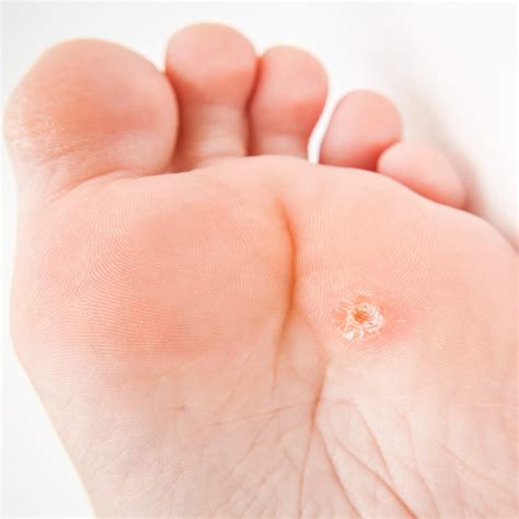 Corns and Calluses - Brampton Foot Clinic