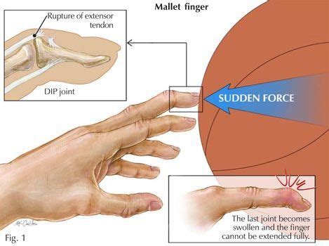 The 25+ best Mallet finger splint ideas on Pinterest | Splint for ...