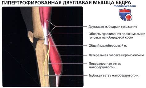 МРТ при гипертрофии двуглавой мышцы бедра