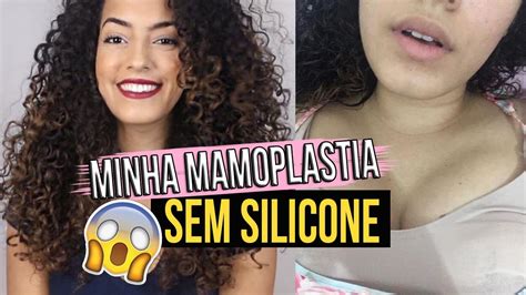 Mastopexia Cicatrizes Fotos Antes E Depois
