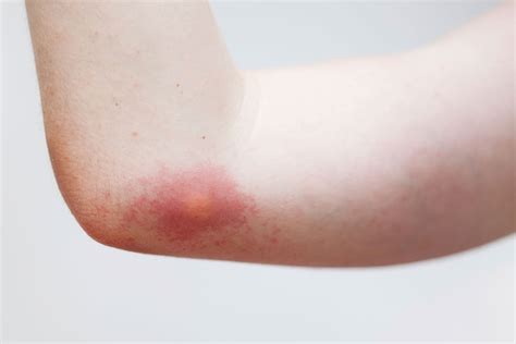 treat insect bites ascension