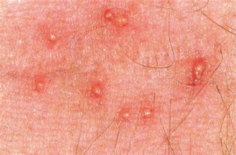 Invisible Bug Bites: Disgusting and Itchy