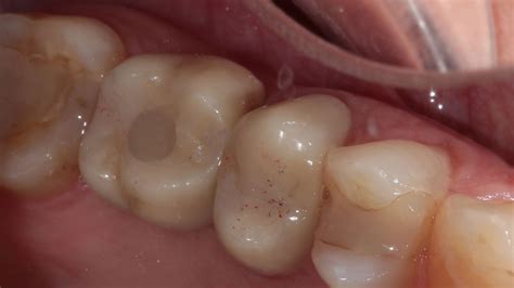 Имплантни решенија | Dentizar