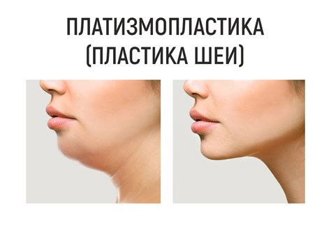 Платизмопластика